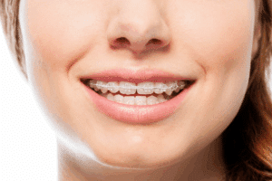 Clear Braces for Adults in Pembroke Pines and Plantation, FL